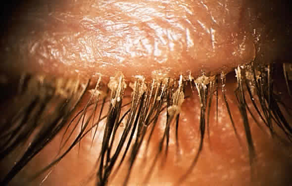 Home-Treat for Demodex Mites on Eyelashes | King LASIK